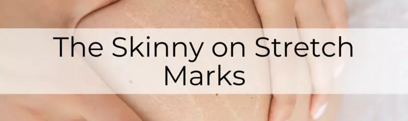 stretch marks causes main-post-image
