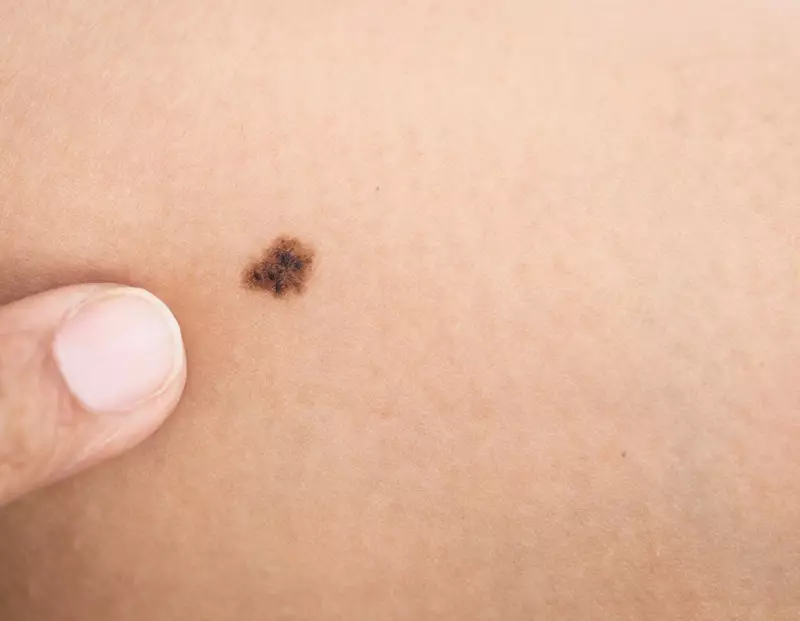congenital moles birthmarks
