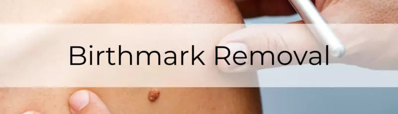 birthmark removal main-post-image