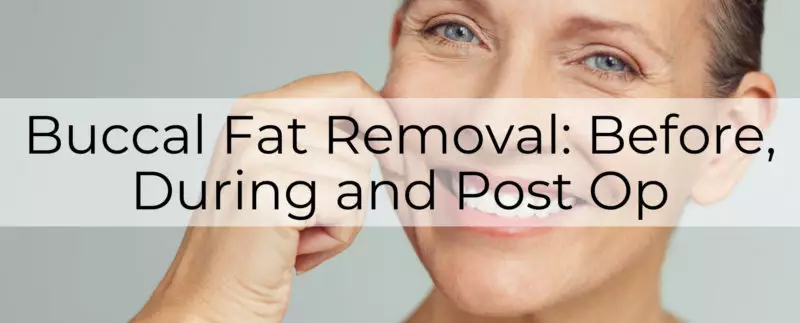 buccal fat removal main-post-image