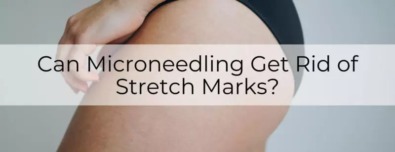 Can Microneedling Get Rid of Stretch Marks main-post-image